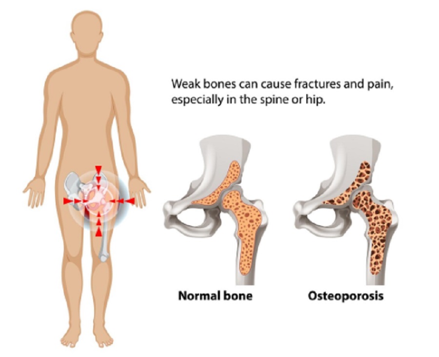 Osteoporosis: Si Tulang Rapuh yang Sering Terlupakan